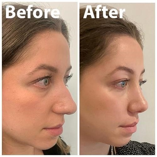 what is a closed rhinoplasty