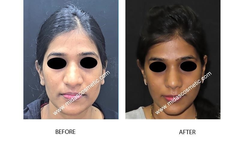 what is a closed rhinoplasty