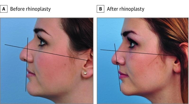 rhinoplasty surgery cost