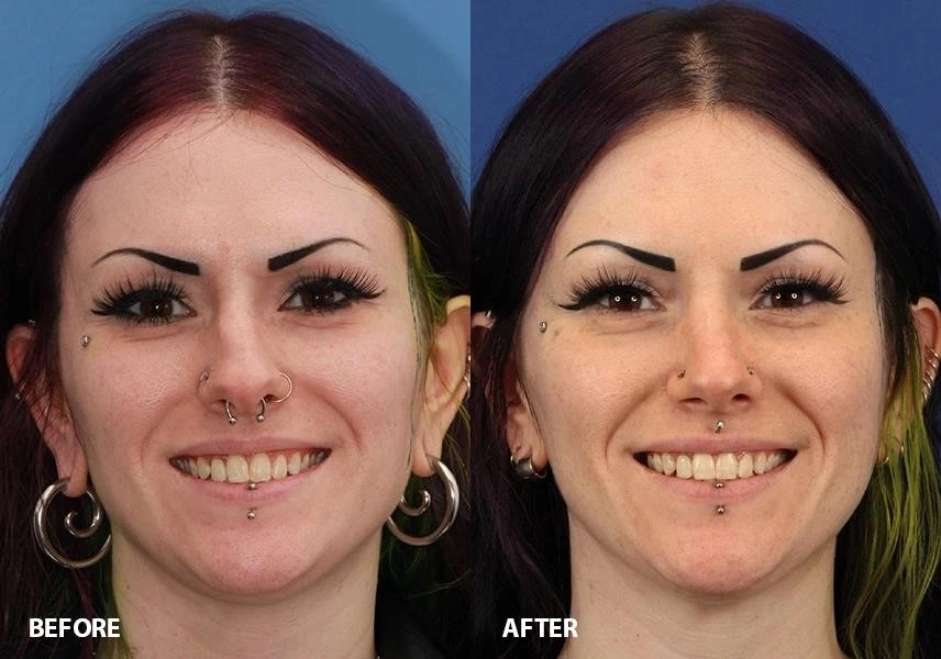 rhinoplasty surgery cost